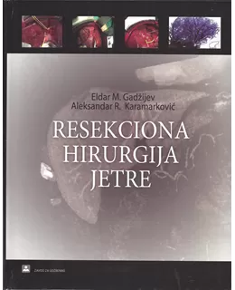 resekciona_hirurgija_jetre__cd